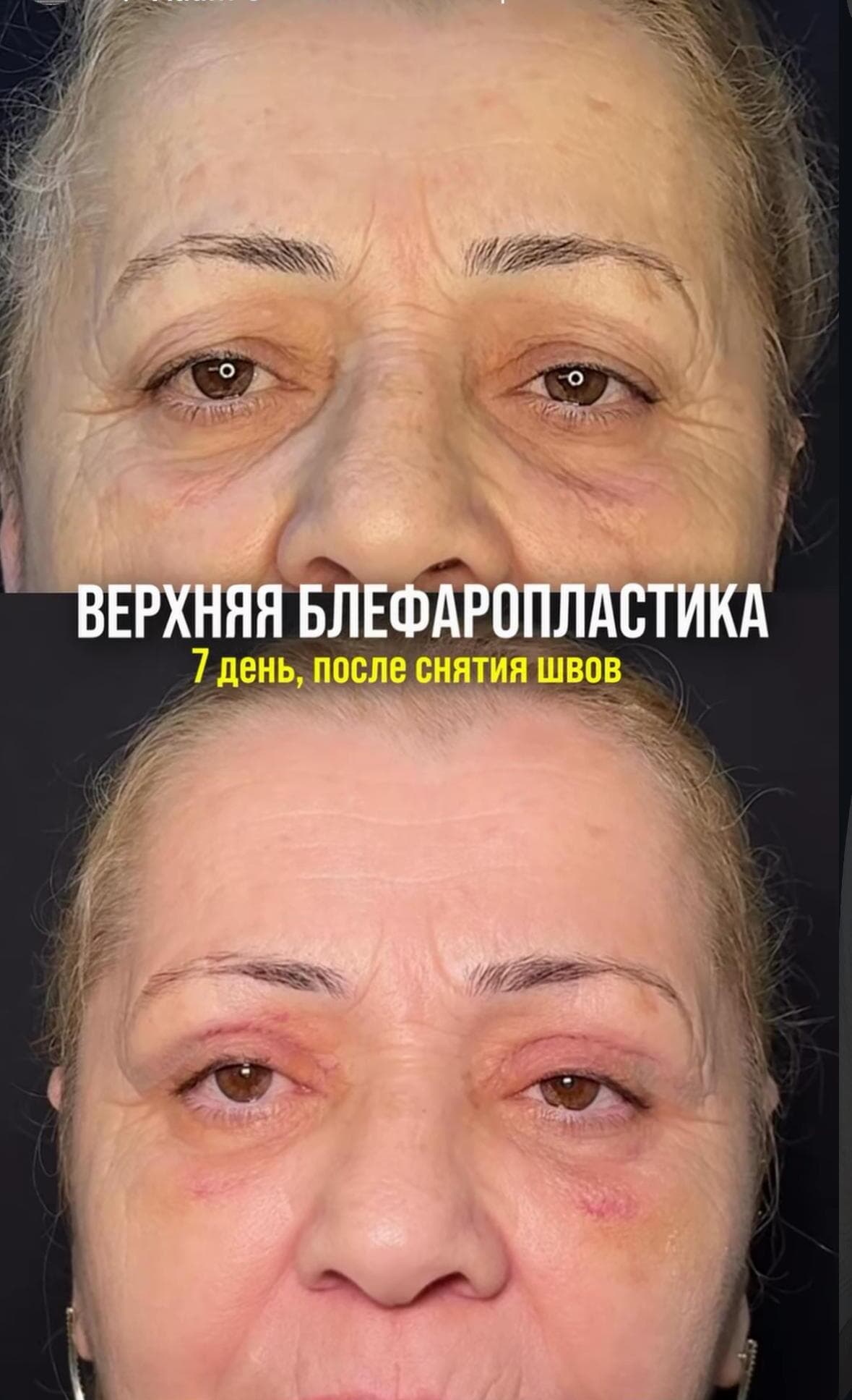 Верхняя блефаропластика