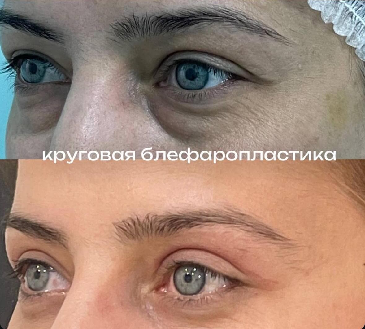 Круговая блефаропластика